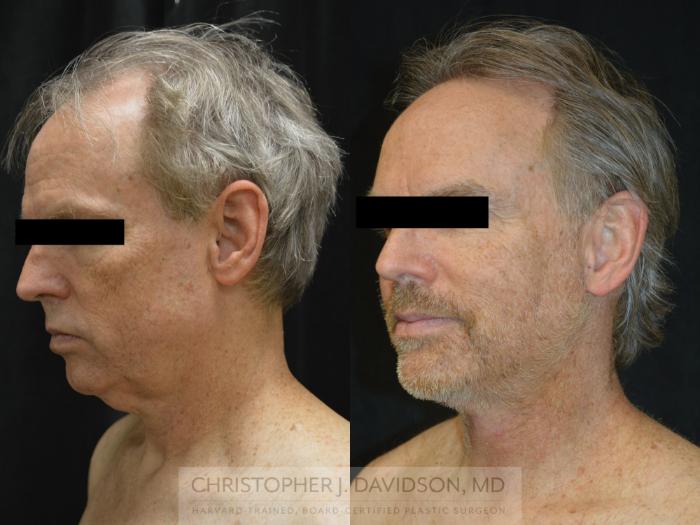 Facelift Surgery Case 263 Before & After Right Oblique | Wellesley, MA | Christopher J. Davidson, MD