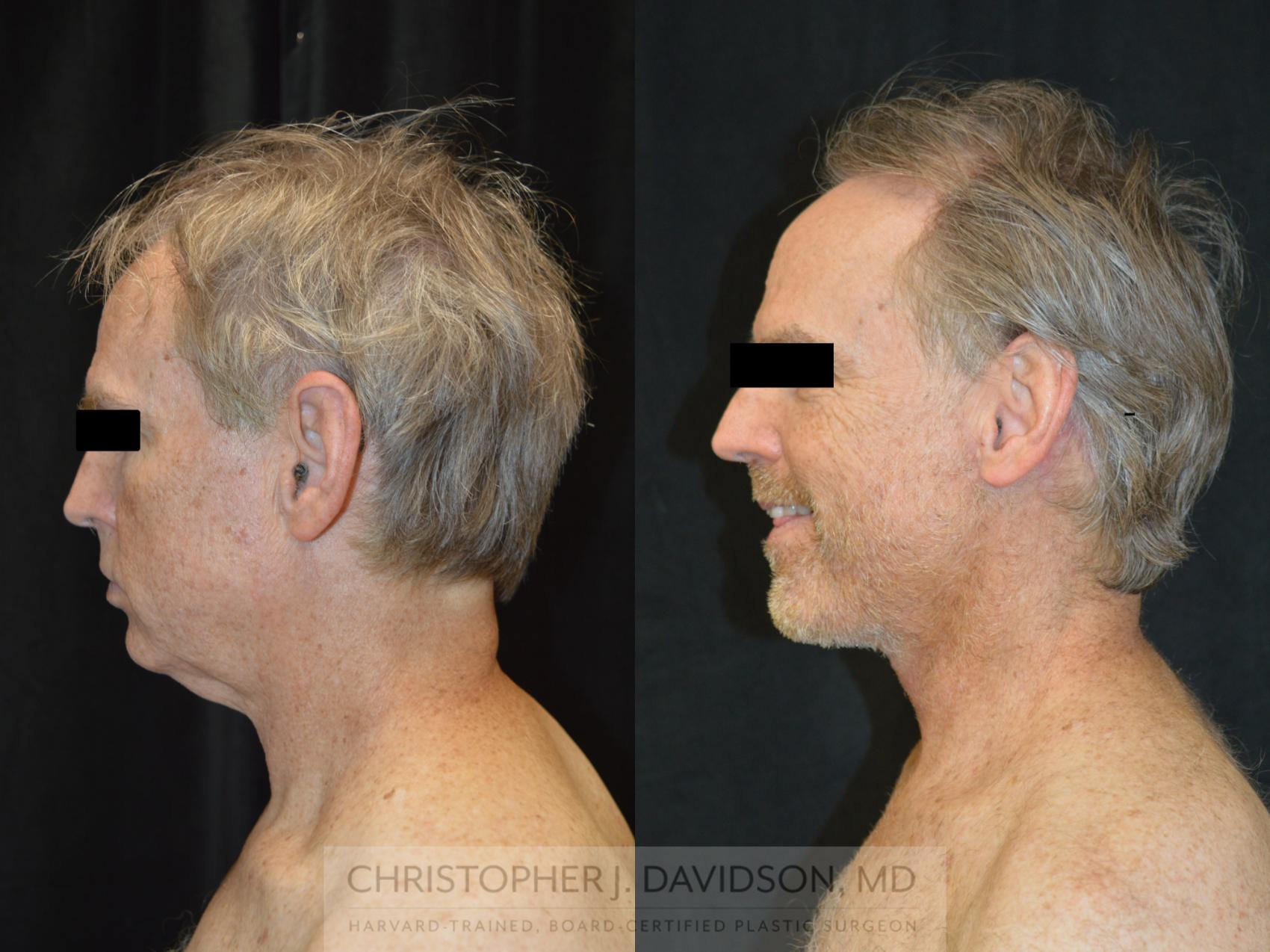 Facelift Surgery Case 263 Before & After Right Side | Wellesley, MA | Christopher J. Davidson, MD