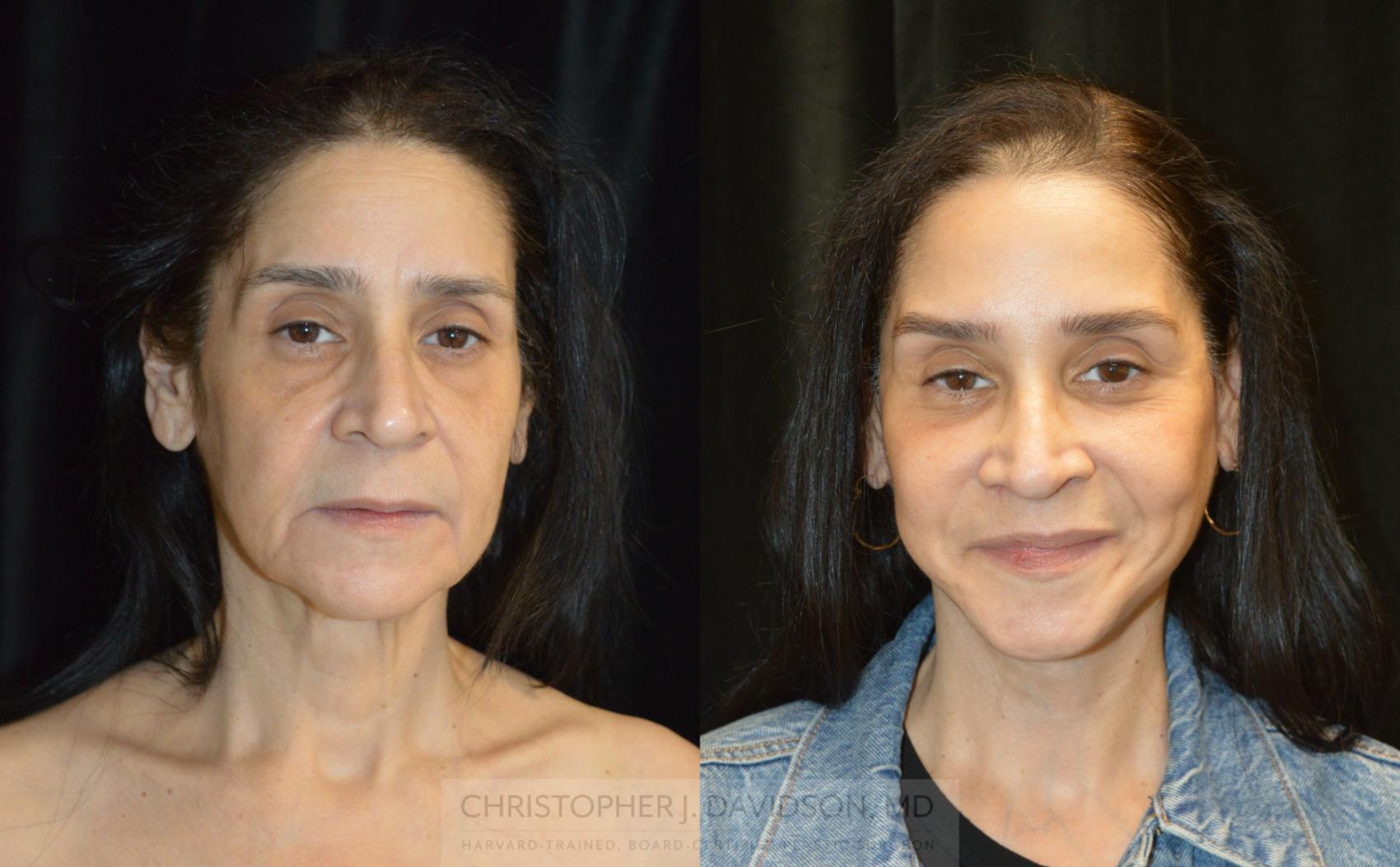 Facelift Surgery Case 266 Before & After Front | Wellesley, MA | Christopher J. Davidson, MD
