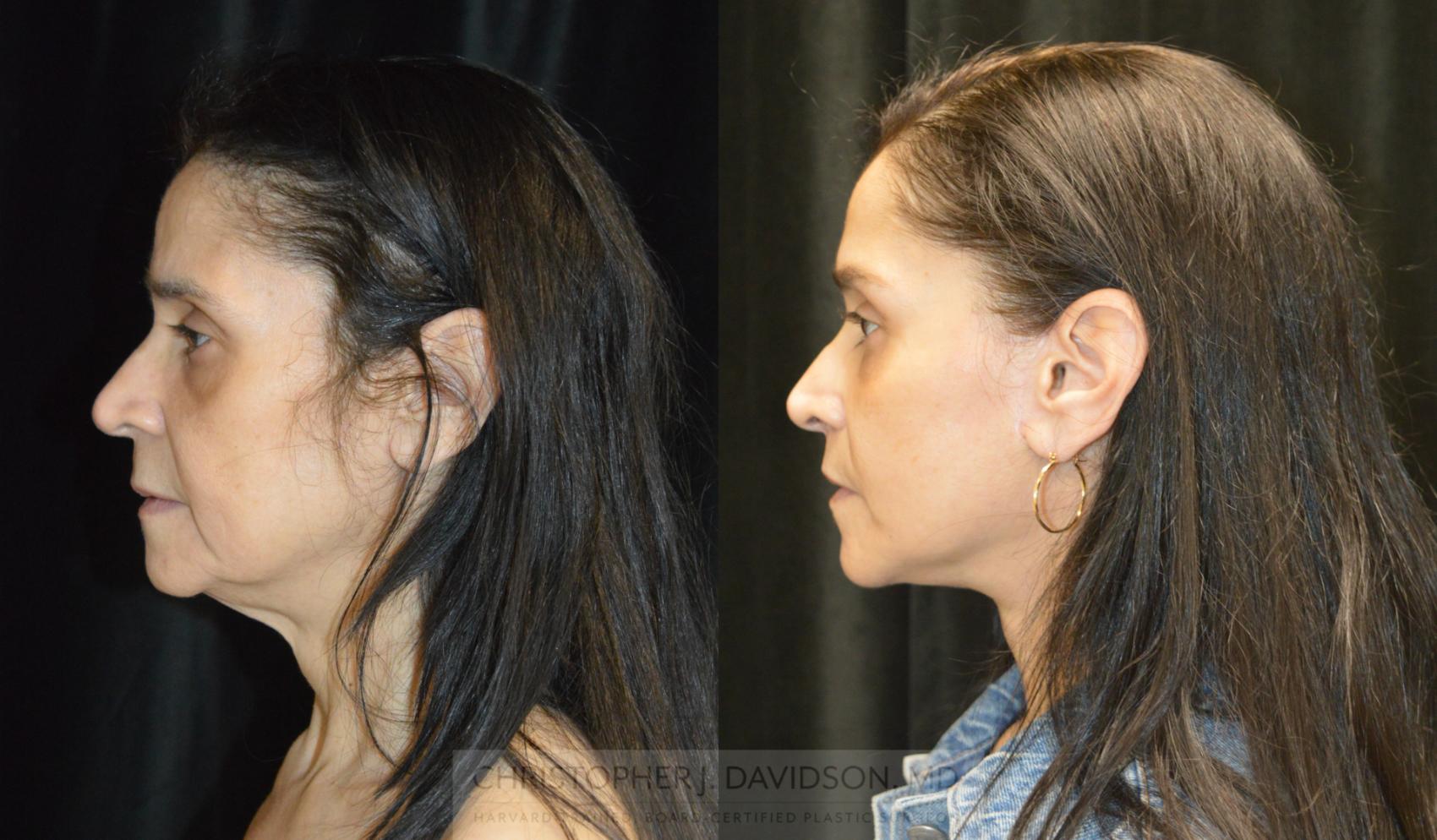 Facelift Surgery Case 266 Before & After Left Side | Wellesley, MA | Christopher J. Davidson, MD