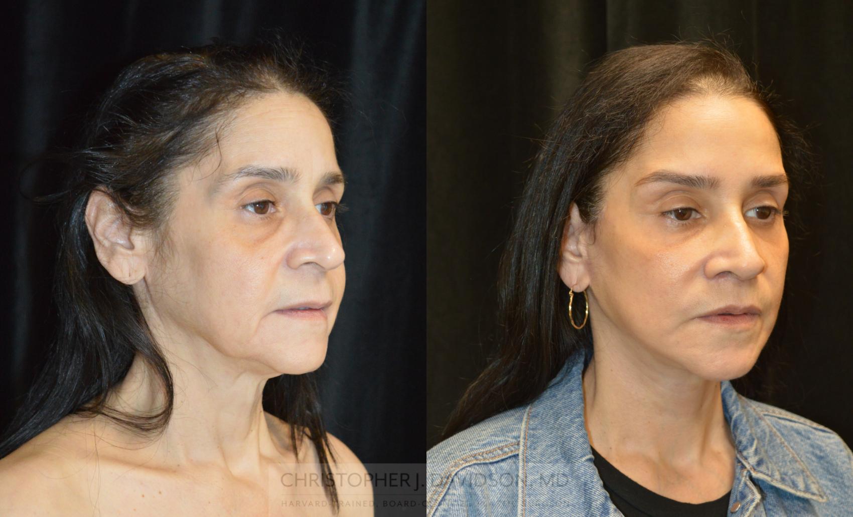 Facelift Surgery Case 266 Before & After Right Oblique | Wellesley, MA | Christopher J. Davidson, MD