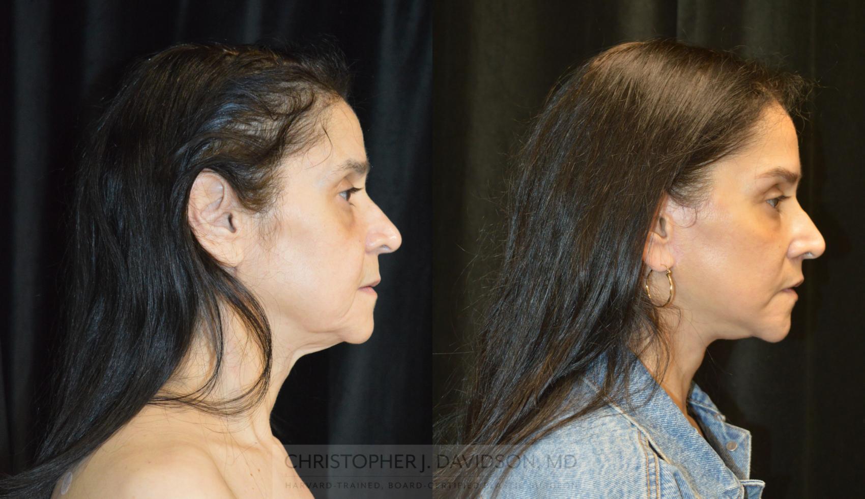 Facelift Surgery Case 266 Before & After Right Side | Wellesley, MA | Christopher J. Davidson, MD