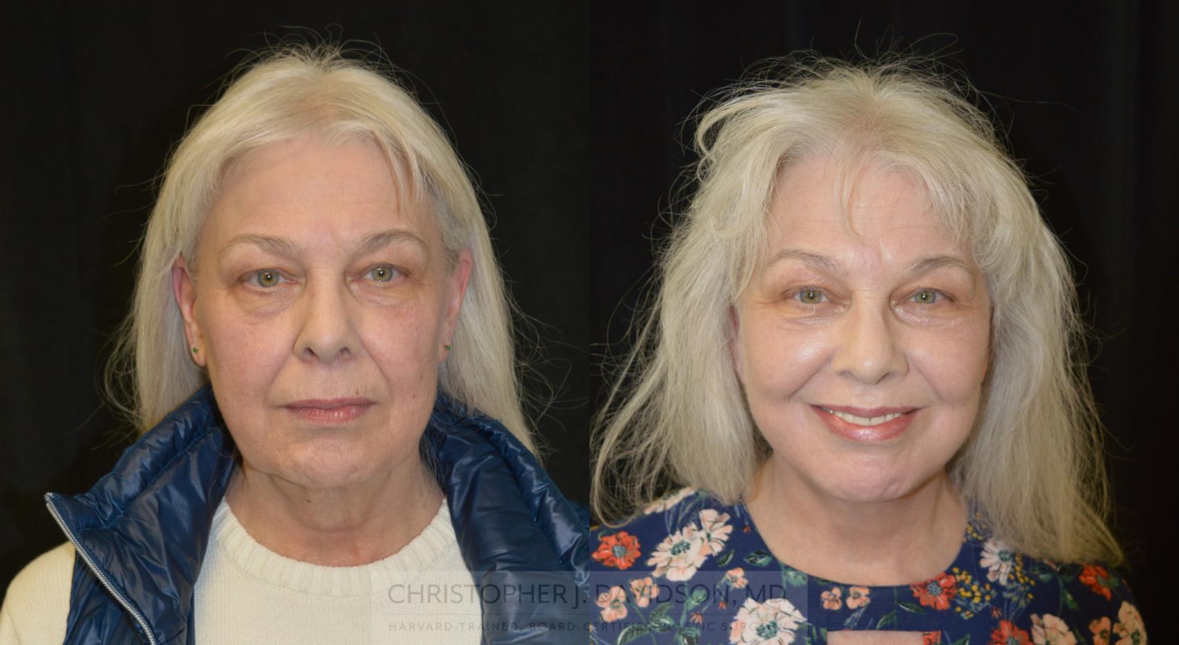 Facelift Surgery Case 270 Before & After Front | Boston, MA | Christopher J. Davidson, MD