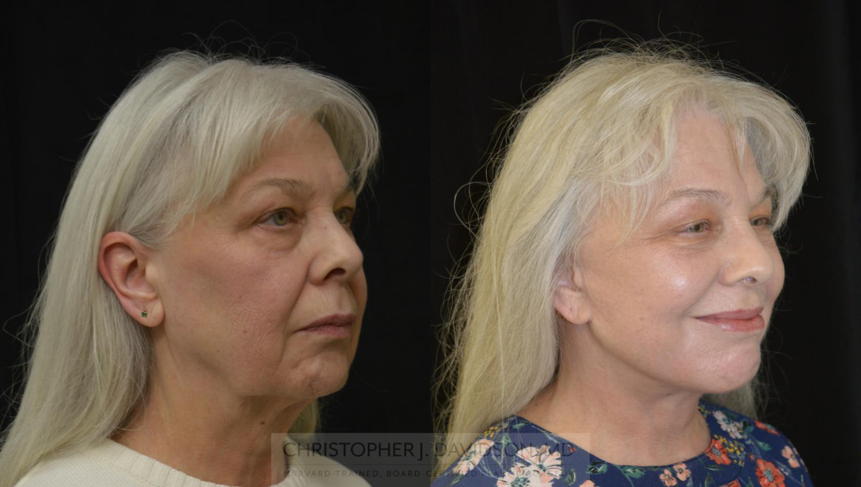 Facelift Surgery Case 270 Before & After Left Oblique | Wellesley, MA | Christopher J. Davidson, MD