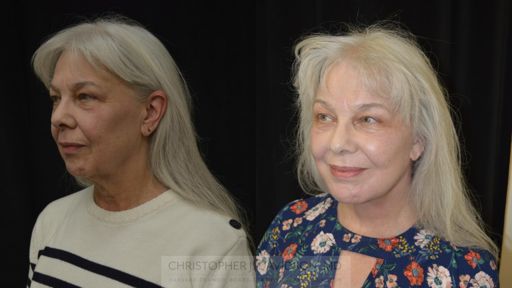 Facelift Surgery Case 270 Before & After Right Oblique | Boston, MA | Christopher J. Davidson, MD