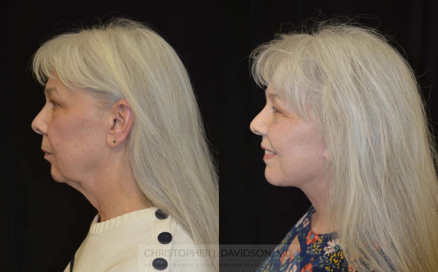 Facelift Surgery Case 270 Before & After Right Side | Boston, MA | Christopher J. Davidson, MD