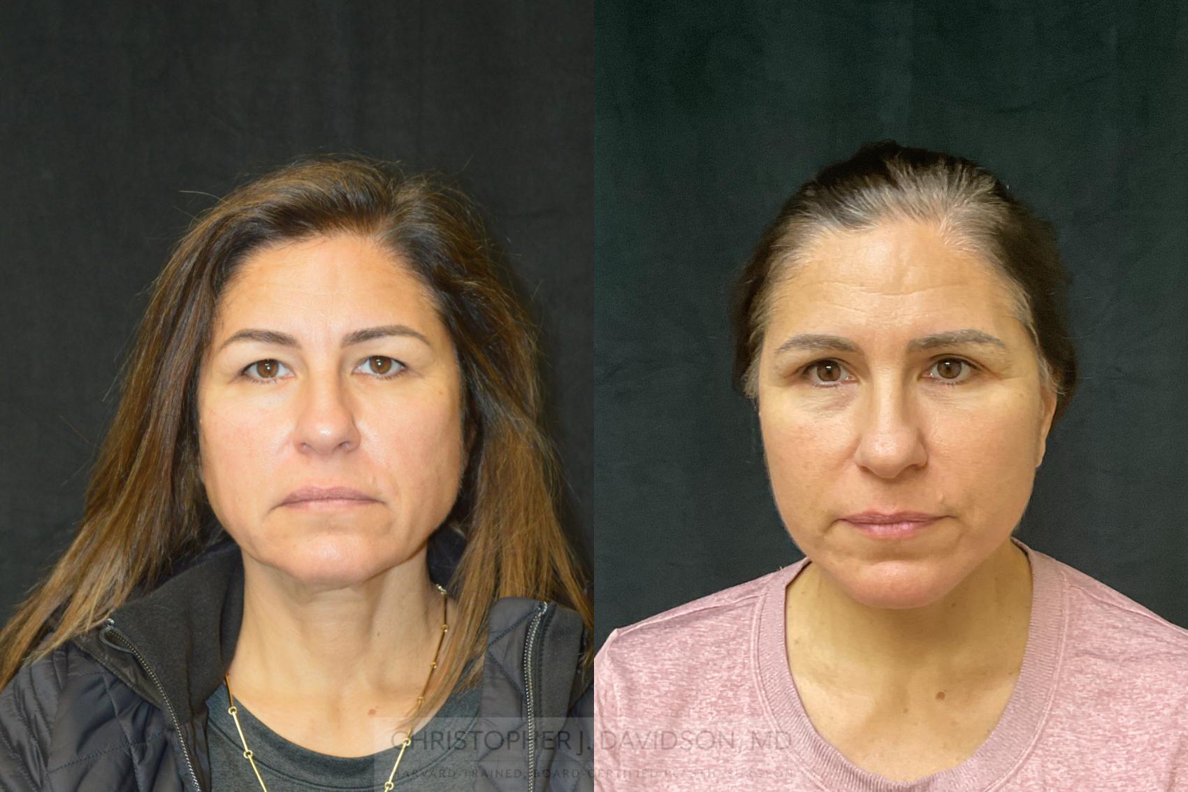 Facelift Surgery Case 276 Before & After Front | Wellesley, MA | Christopher J. Davidson, MD