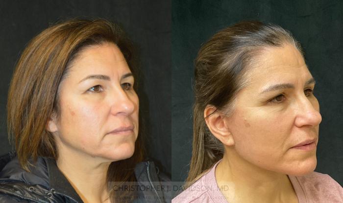 Facelift Surgery Case 276 Before & After Left Oblique | Boston, MA | Christopher J. Davidson, MD