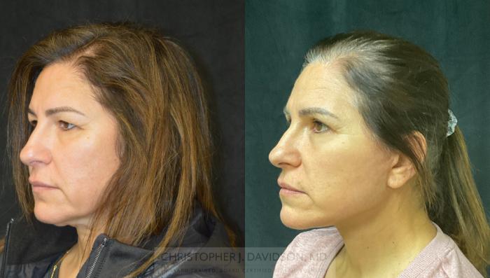 Facelift Surgery Case 276 Before & After Right Oblique | Boston, MA | Christopher J. Davidson, MD