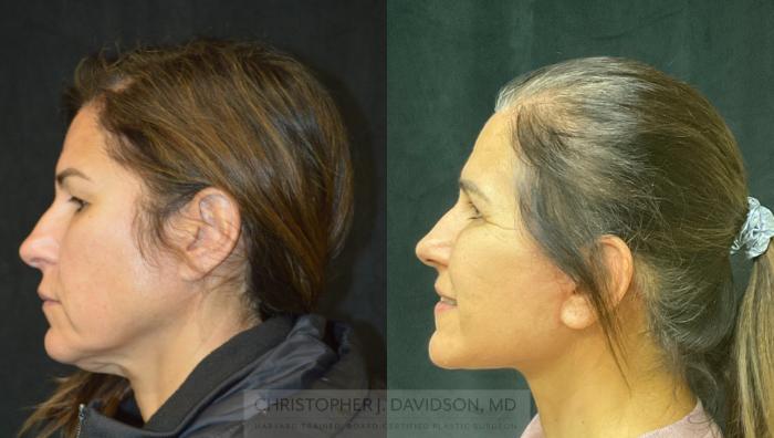 Facelift Surgery Case 276 Before & After Right Side | Boston, MA | Christopher J. Davidson, MD