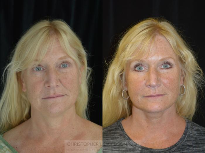 Facelift Surgery Case 284 Before & After Front | Wellesley, MA | Christopher J. Davidson, MD