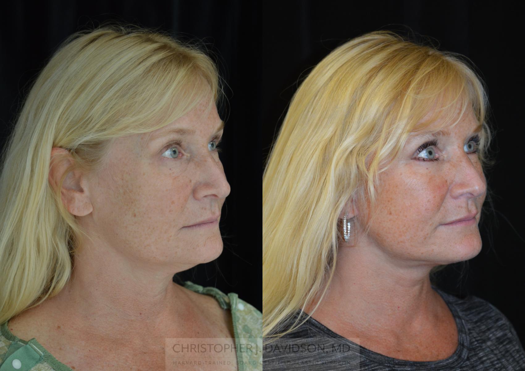 Facelift Surgery Case 284 Before & After Right Oblique | Boston, MA | Christopher J. Davidson, MD