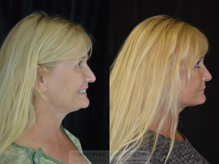 Facelift Surgery Case 284 Before & After Right Side | Wellesley, MA | Christopher J. Davidson, MD