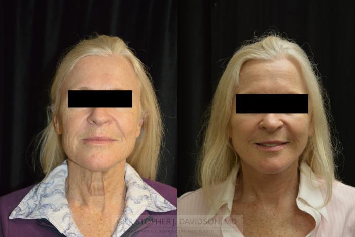 Facelift Surgery Case 287 Before & After Front | Boston, MA | Christopher J. Davidson, MD