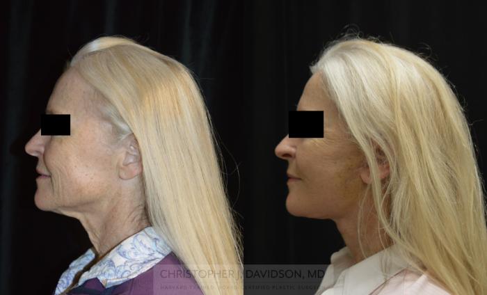 Facelift Surgery Case 287 Before & After Left Side | Boston, MA | Christopher J. Davidson, MD