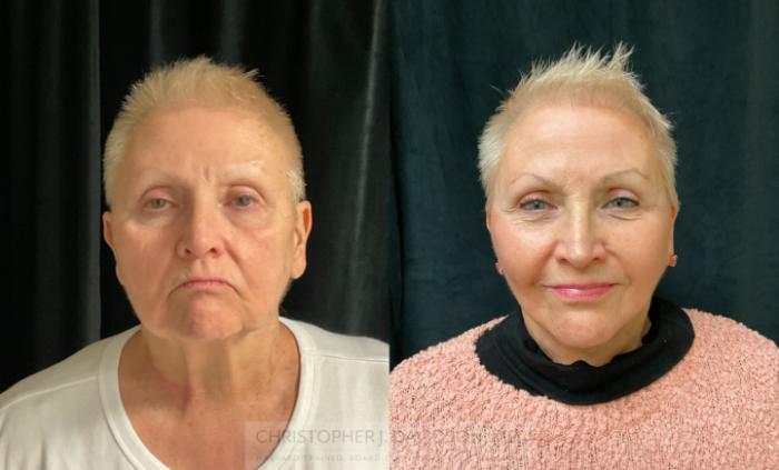 Facelift Surgery Case 290 Before & After Front | Boston, MA | Christopher J. Davidson, MD