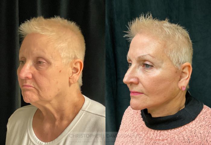 Facelift Surgery Case 290 Before & After Left Oblique | Boston, MA | Christopher J. Davidson, MD