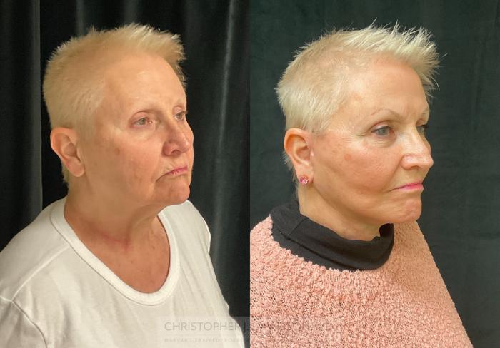 Facelift Surgery Case 290 Before & After Right Oblique | Boston, MA | Christopher J. Davidson, MD