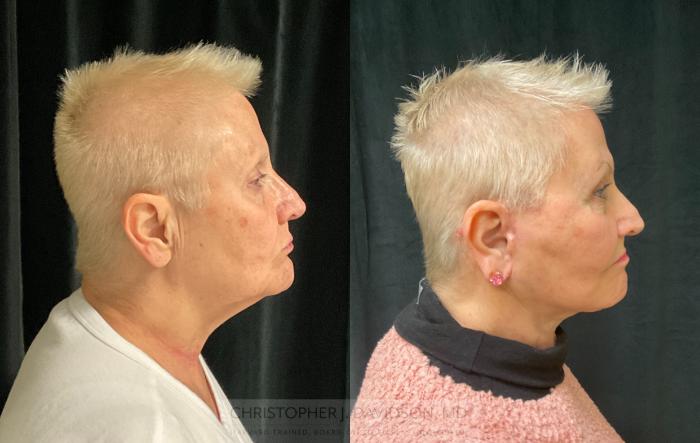 Neck Lift Case 290 Before & After Right Side | Boston, MA | Christopher J. Davidson, MD