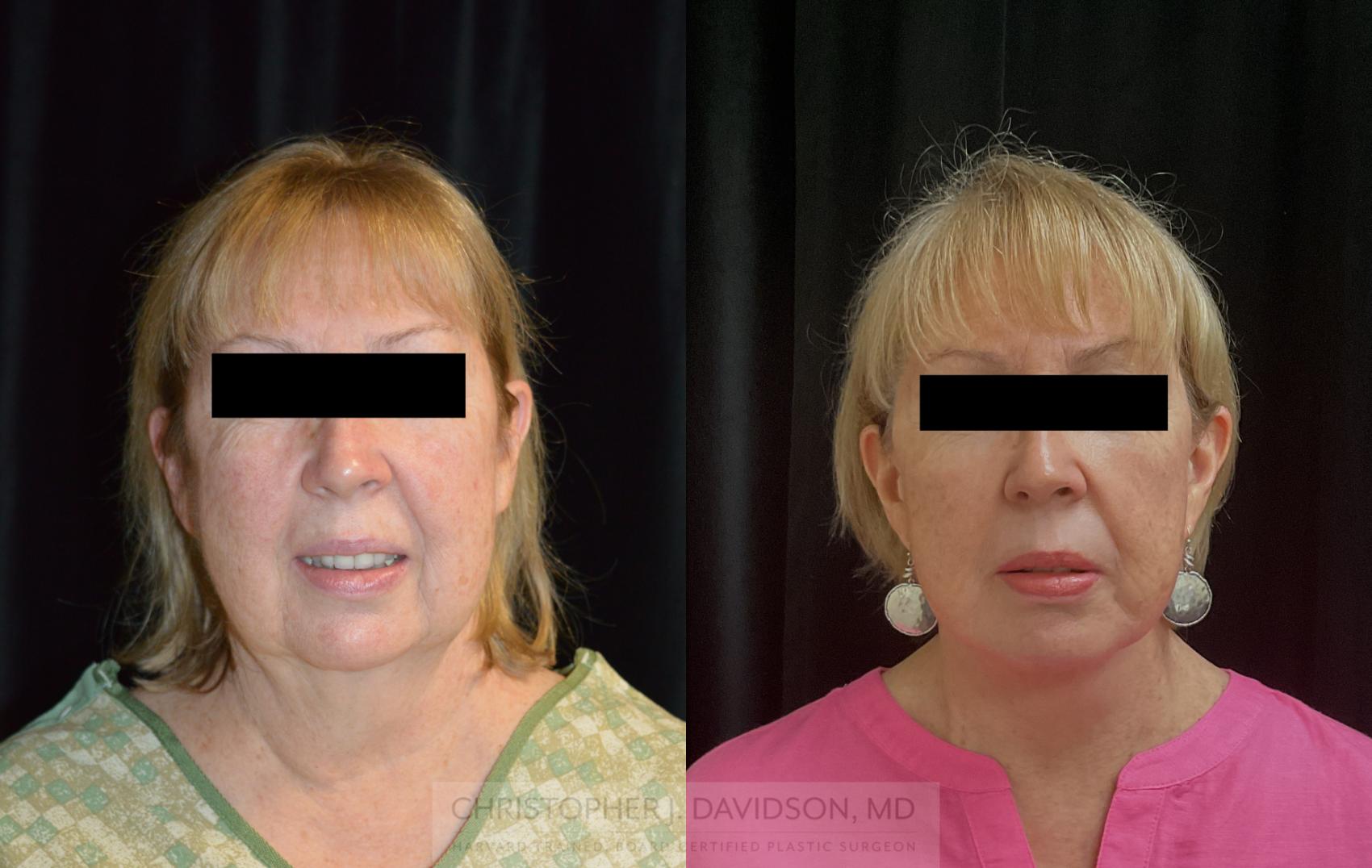 Facelift Surgery Case 292 Before & After Front | Boston, MA | Christopher J. Davidson, MD