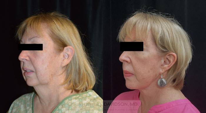 Facelift Surgery Case 292 Before & After Left Oblique | Boston, MA | Christopher J. Davidson, MD