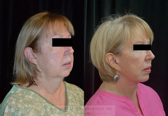 Facelift Surgery Case 292 Before & After Right Oblique | Boston, MA | Christopher J. Davidson, MD