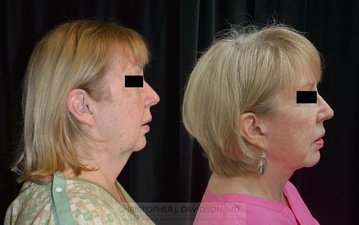 Facelift Surgery Case 292 Before & After Right Side | Boston, MA | Christopher J. Davidson, MD
