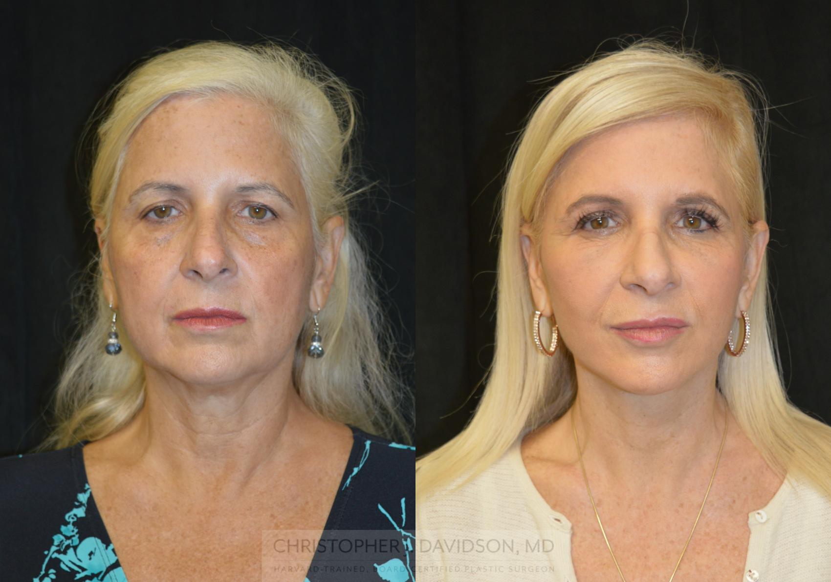 Facelift Surgery Case 296 Before & After Front | Boston, MA | Christopher J. Davidson, MD