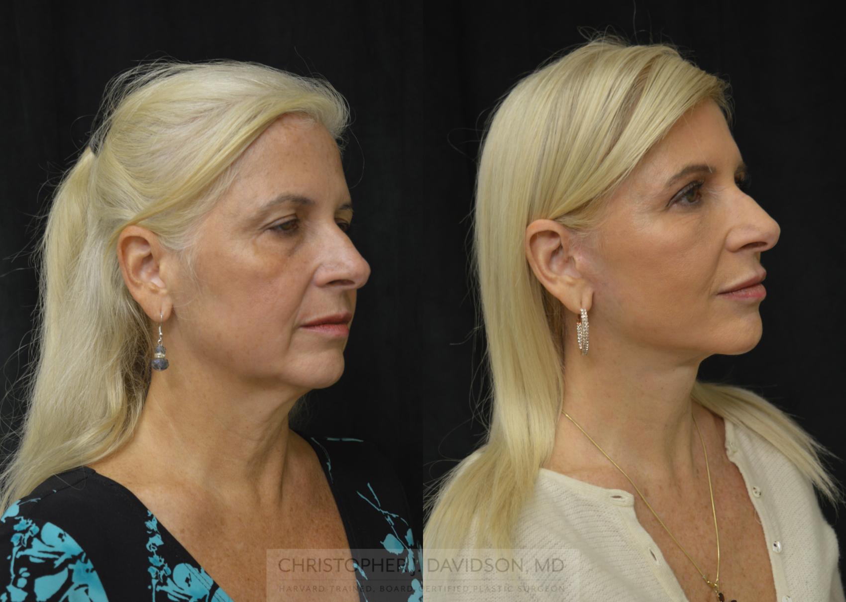Facelift Surgery Before and After Pictures Case 296 Boston, MA