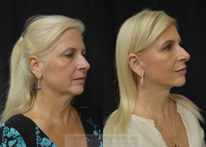 Facelift Surgery Case 296 Before & After Left Oblique | Boston, MA | Christopher J. Davidson, MD