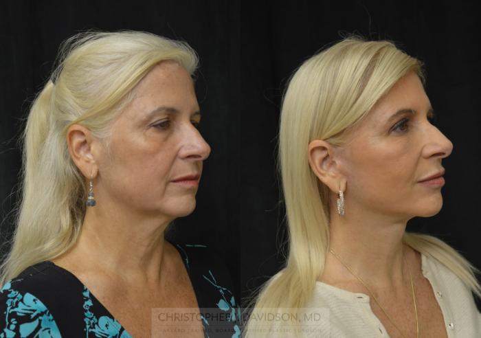 Facelift Surgery Case 296 Before & After Right Oblique | Boston, MA | Christopher J. Davidson, MD