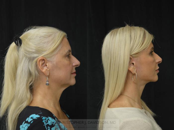 Facelift Surgery Case 296 Before & After Right Side | Boston, MA | Christopher J. Davidson, MD