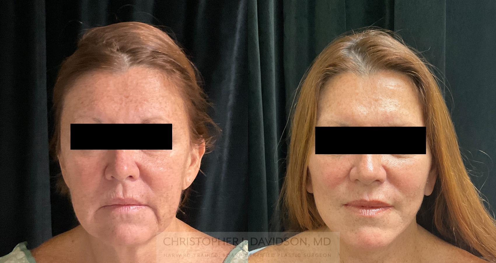 Neck Lift Case 299 Before & After Front | Boston, MA | Christopher J. Davidson, MD