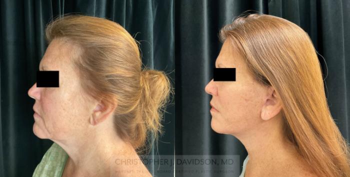 Facelift Surgery Case 299 Before & After Left Side | Boston, MA | Christopher J. Davidson, MD
