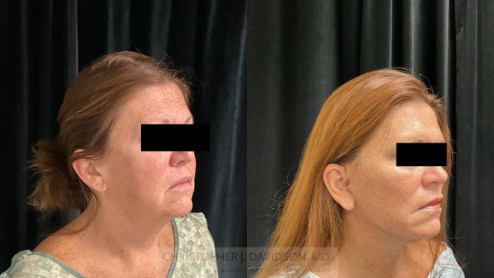 Facelift Surgery Case 299 Before & After Right Oblique | Boston, MA | Christopher J. Davidson, MD
