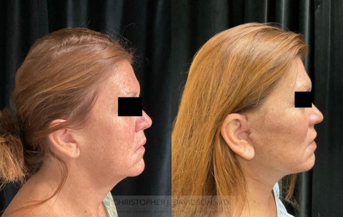 Neck Lift Case 299 Before & After Right Side | Boston, MA | Christopher J. Davidson, MD