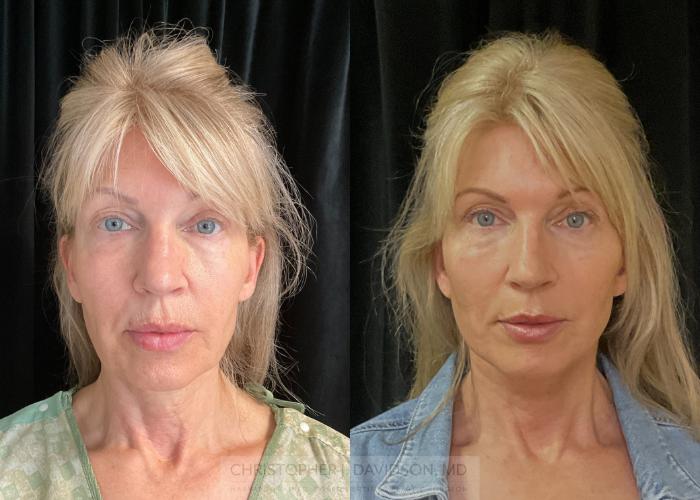 Facelift Surgery Case 302 Before & After Front | Boston, MA | Christopher J. Davidson, MD