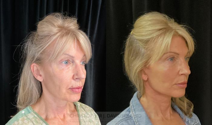 Facelift Surgery Case 302 Before & After Right Oblique | Boston, MA | Christopher J. Davidson, MD