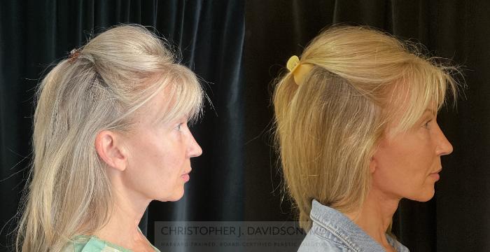 Facelift Surgery Case 302 Before & After Right Side | Boston, MA | Christopher J. Davidson, MD