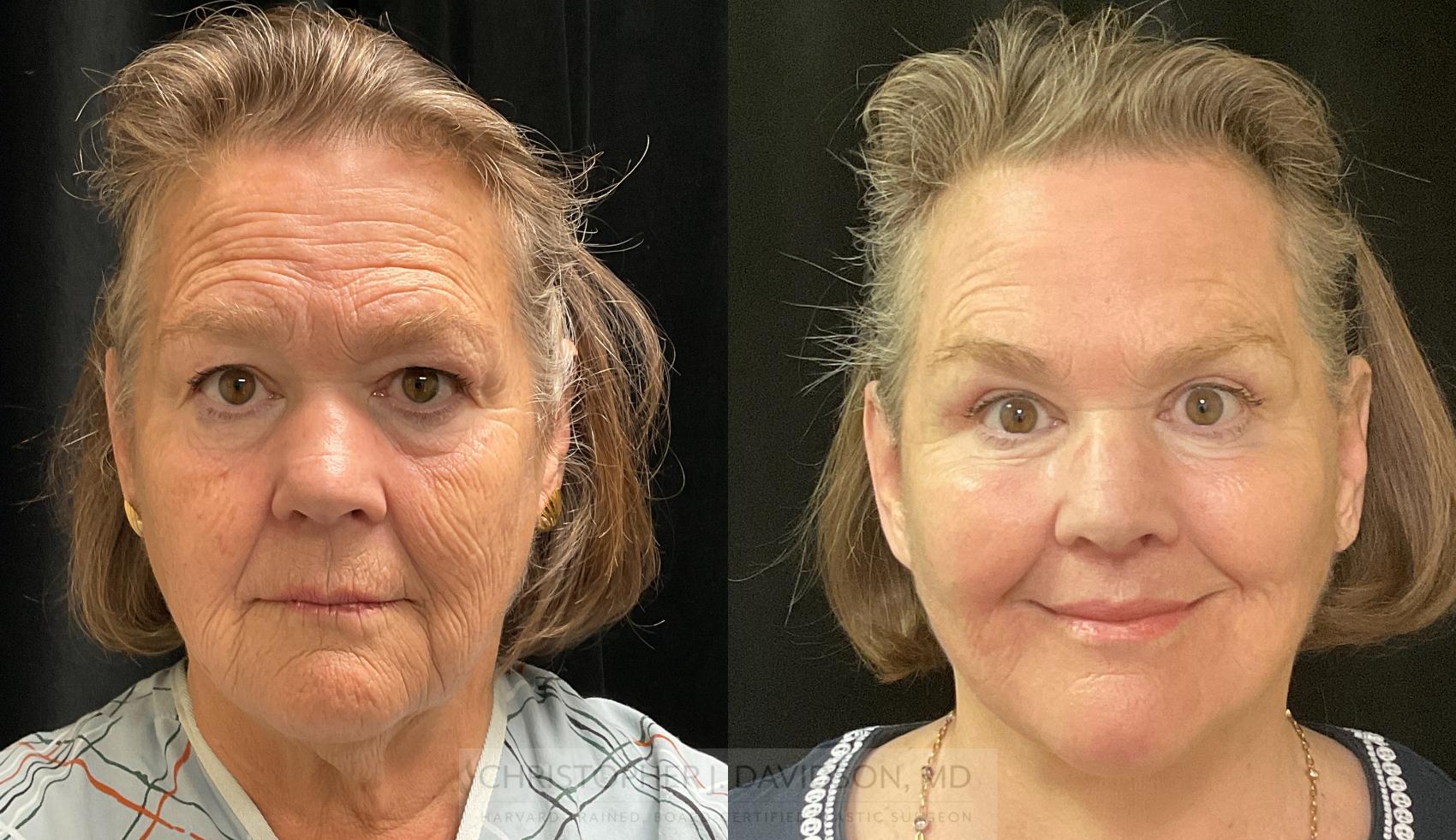 Facelift Surgery Case 308 Before & After Front | Boston, MA | Christopher J. Davidson, MD