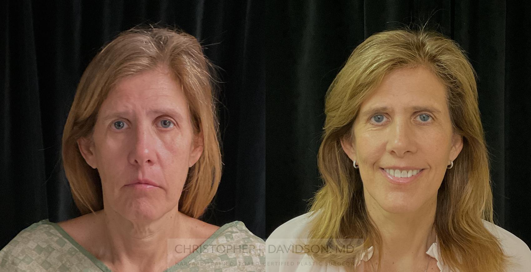 Facelift Surgery Case 309 Before & After Front | Boston, MA | Christopher J. Davidson, MD