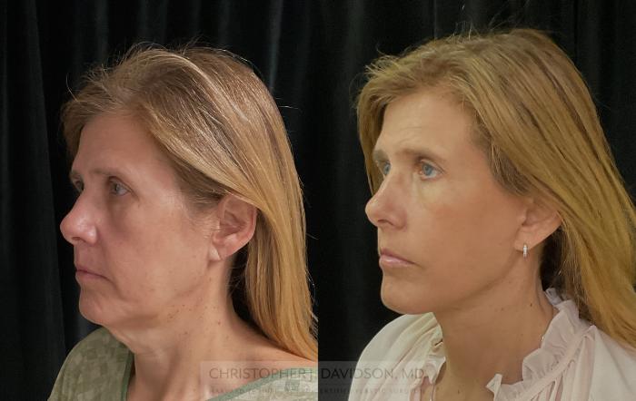 Facelift Surgery Case 309 Before & After Left Oblique | Boston, MA | Christopher J. Davidson, MD