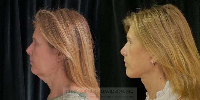 Facelift Surgery Case 309 Before & After Left Side | Boston, MA | Christopher J. Davidson, MD