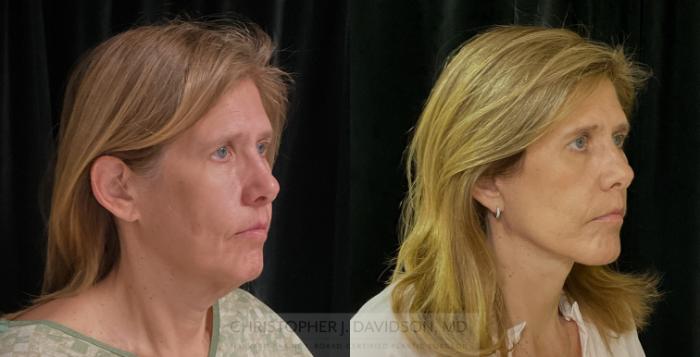 Facelift Surgery Case 309 Before & After Right Oblique | Boston, MA | Christopher J. Davidson, MD