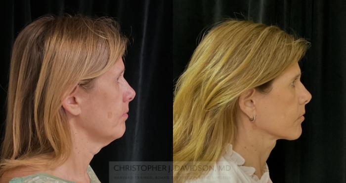 Facelift Surgery Case 309 Before & After Right Side | Boston, MA | Christopher J. Davidson, MD