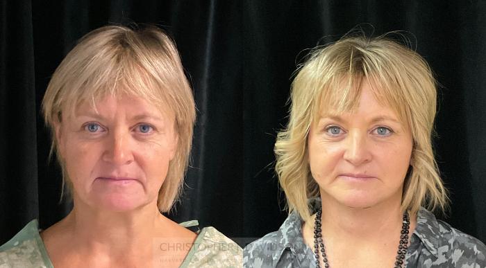 Facelift Surgery Case 329 Before & After Front | Boston, MA | Christopher J. Davidson, MD
