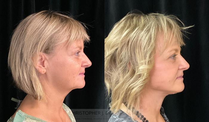 Facelift Surgery Case 329 Before & After Right Side | Boston, MA | Christopher J. Davidson, MD