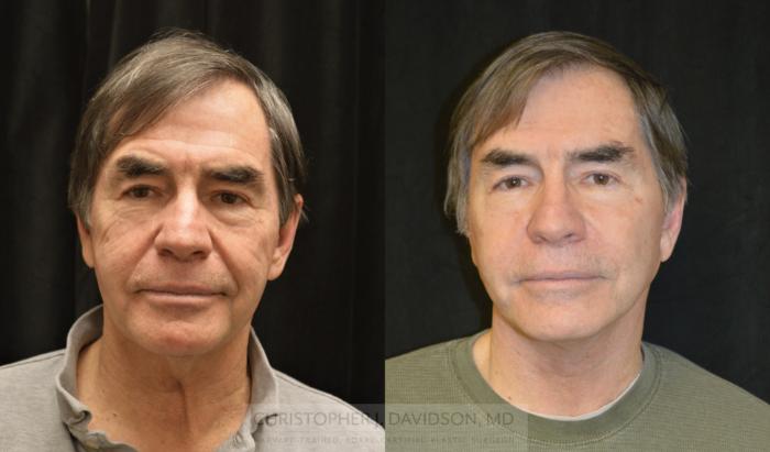 Neck Lift Case 330 Before & After Front | Boston, MA | Christopher J. Davidson, MD