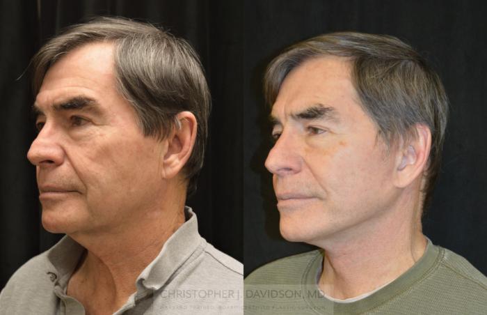 Facelift Surgery Case 330 Before & After Left Oblique | Boston, MA | Christopher J. Davidson, MD