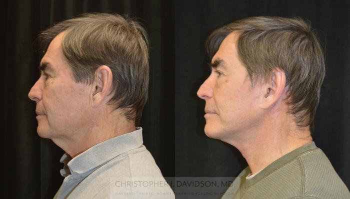 Facelift Surgery Case 330 Before & After Left Side | Boston, MA | Christopher J. Davidson, MD